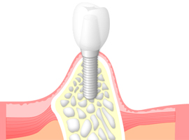 骨結合（オッセオインテグレーション）しないケース