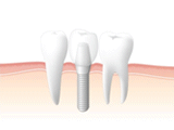 インプラント